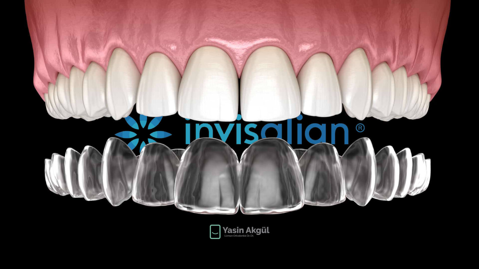 Invisalign Effaf Plak Uygulamas Yapt Rmadan Bilmeniz Gerekenler