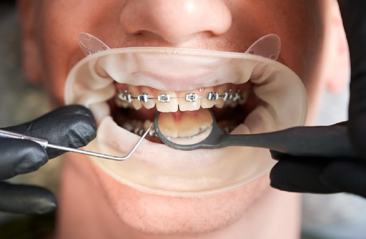 hizlandirilmis-ortodontik-tedavi